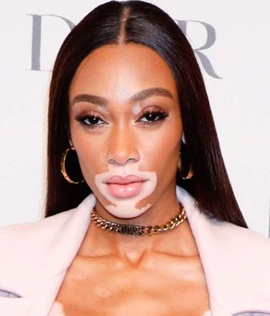 Model Winnie Harlow